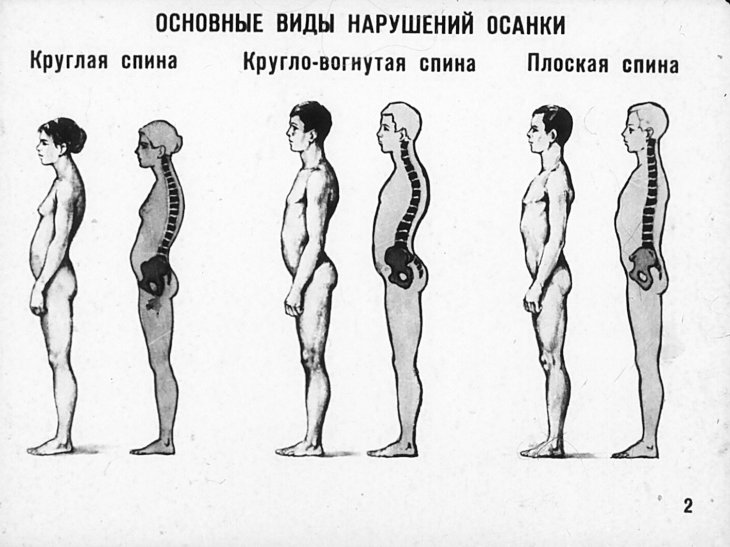 Кадр 3 диафильма «Предупреждение и исправление нарушений осанки»